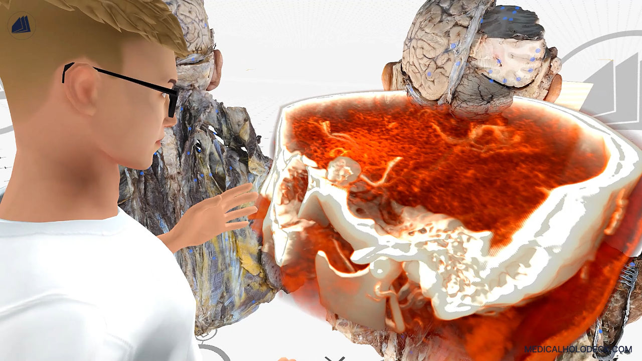 Brain aneurysms - the silent threat thumbnail 1